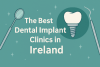 The Best Dental Implant Clinics in Ireland bikrisohoj